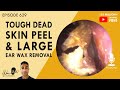 629 - Tough Dead Skin Peel & Large Ear Wax Removal