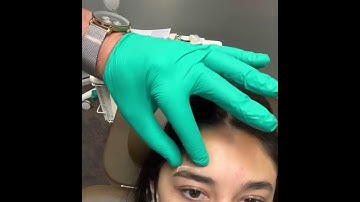 Spock Brow Correction