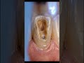 Rotten Front Tooth Restored to Perfection 😱🦷 | Amazing Dental Crown Transformation #shorts