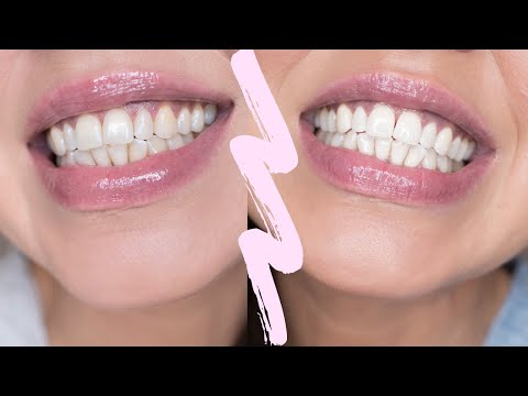 Video: Hampaiden valkaisuliuskojen käyttö: 15 vaihetta (kuvilla)