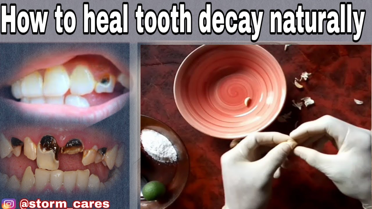 How to cure or prevent tooth decay and cavities using this herbal mixtures storm cares YouTube
