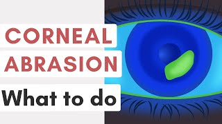 How To Manage A Corneal Abrasion