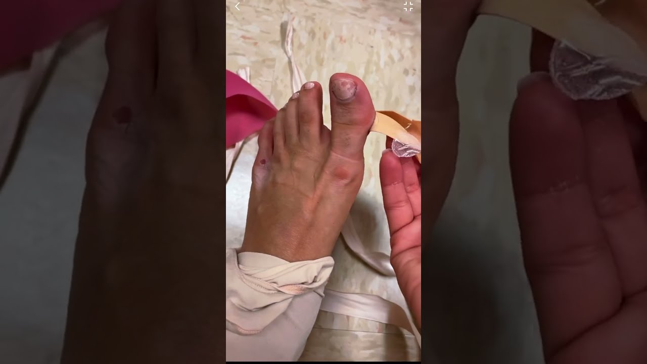 Ballerina Problem Feet Look Like After A Show 