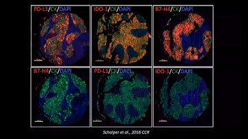 Evaluating tumor-immune cell interactions in human lung cancer using multiparametric and spatially..