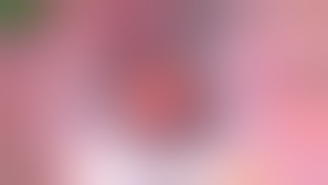 Dislocated IOL My Modified Yamane Technique w 25g Haptic Externalization of Delicate Sensar Haptic