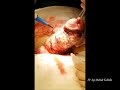 Blood sparing myomectomy using tourniquet  myomectomie avec la scurit dun garrot