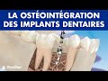 Ostéointégration des implants dentaires ©