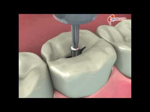 Video: 3 Cara Sembunyikan Kerosakan Gigi