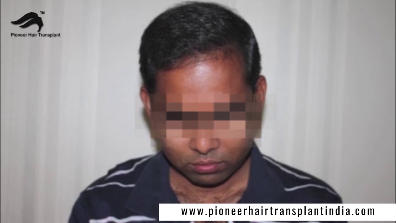 Hair Care Centre In Bangalore Best Hair Transplant For Hair
