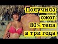 Наталья Устинова получила ожог 80% тела в три года