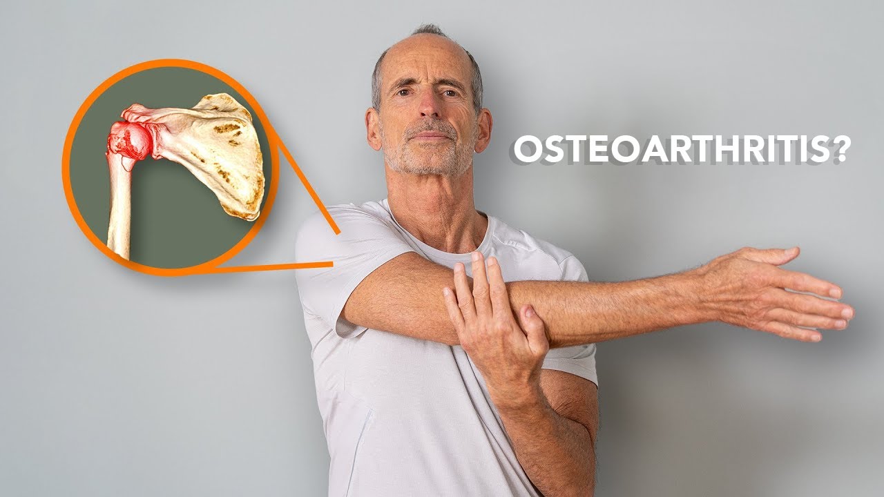 Shoulder Arthrosis Everyone Affected By This Needs To Know YouTube Shoulder arthrosis everyone affected by this needs to know youtube