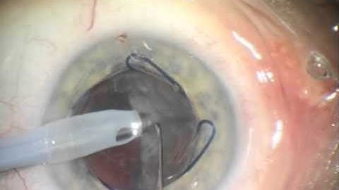 7.0 mm Malyugin Ring®