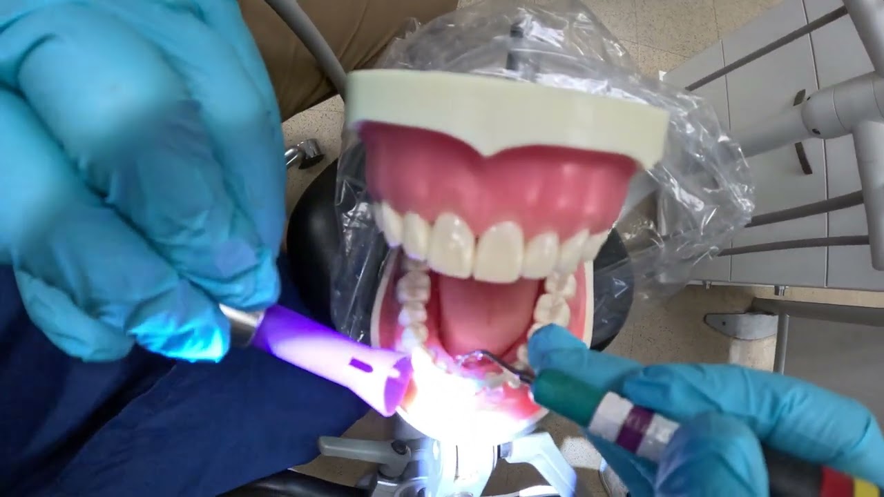 Ultrasonic typodont mandibular anterior for the dental hygiene program and beyond