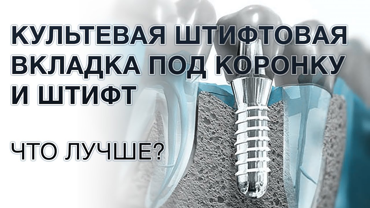 Штифт или культевая вкладка под коронку: что лучше?