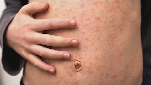 259 confirmed cases of measles reported in Texas