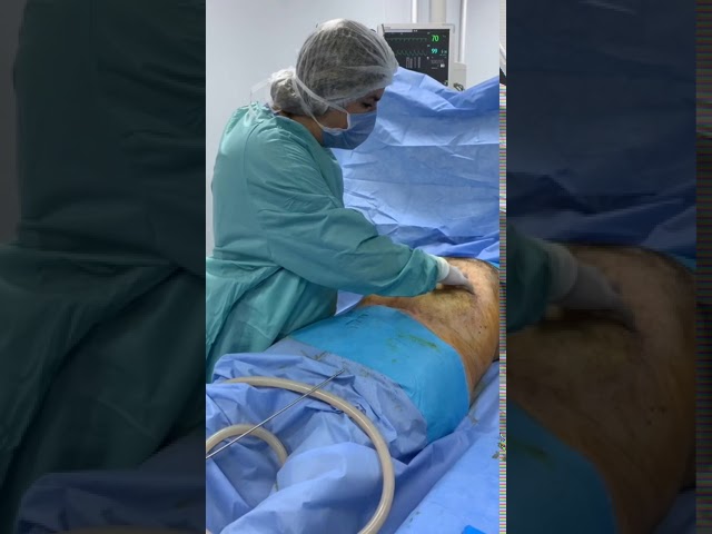 Liposuccion du ventre /Abdominal Liposuction