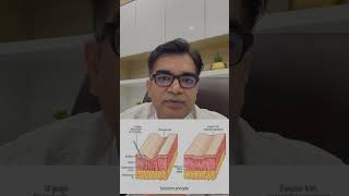 Subcision RF Treatment For Acne Scars | Acne Scar Treatments