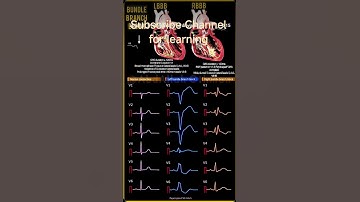 LBBB vs RBBB ECG