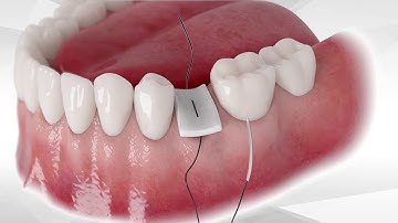 Bond Apatite® protocol for socket grafting without flap reflection
