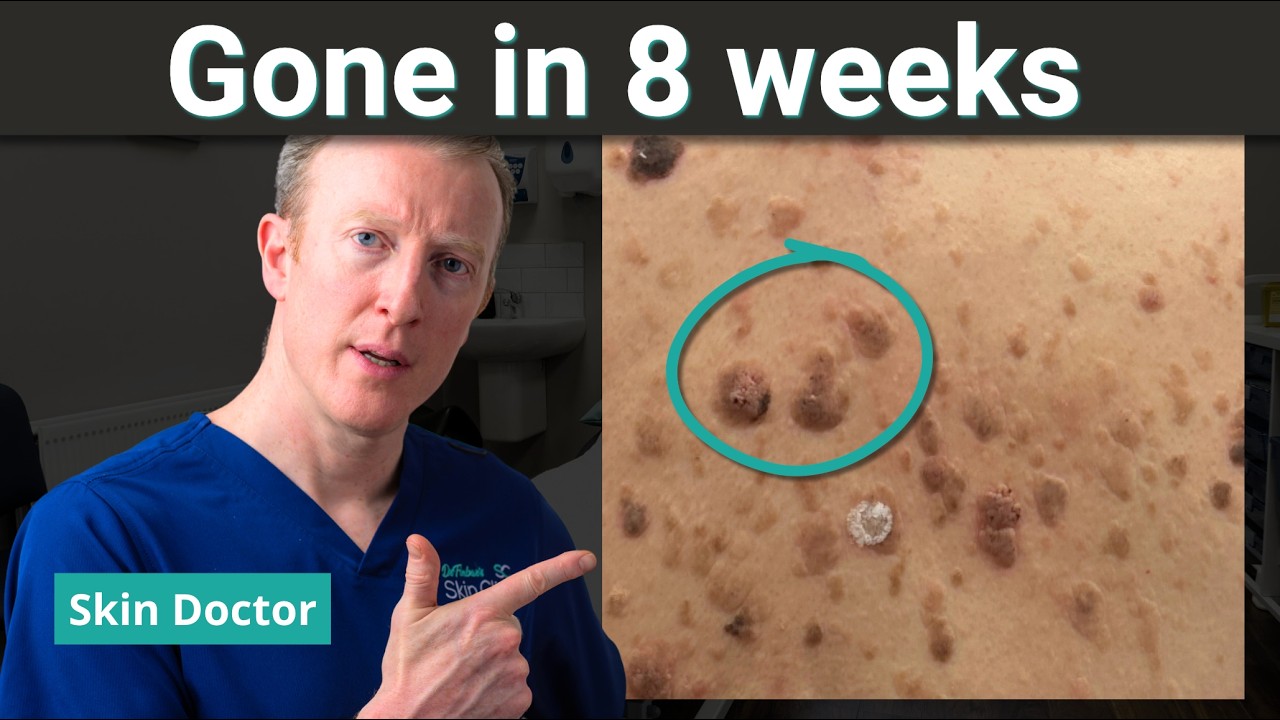 Seborrheic Keratosis Can a Gel Clear It? The Real Evidence