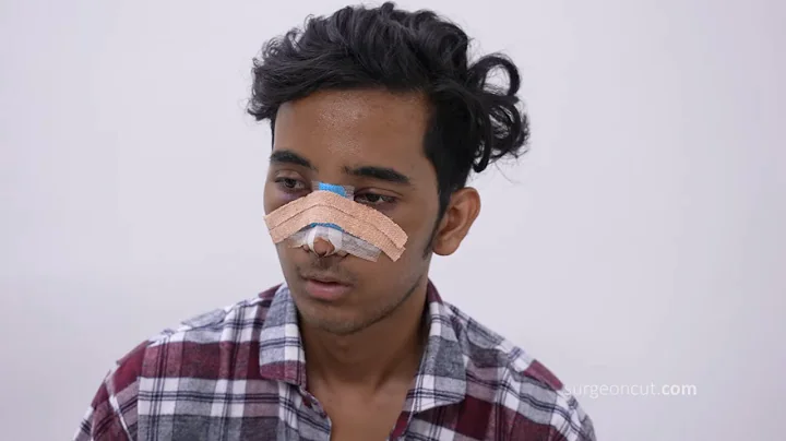 Boy Rhinoplasty | Surgical Nose Job | Dr. Richards...