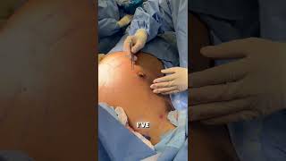Gynecomastia Surgery: Why Liposuction Alone May Not Be Enough | Dr. Greg Lee #shorts