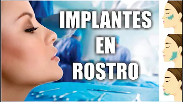 ¿Los implantes de pómulos levantan la cara?