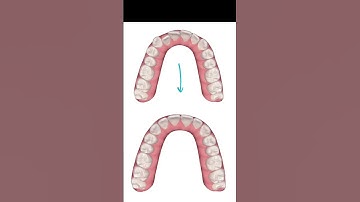 Invisalign Smile Design: Before and After Proposal