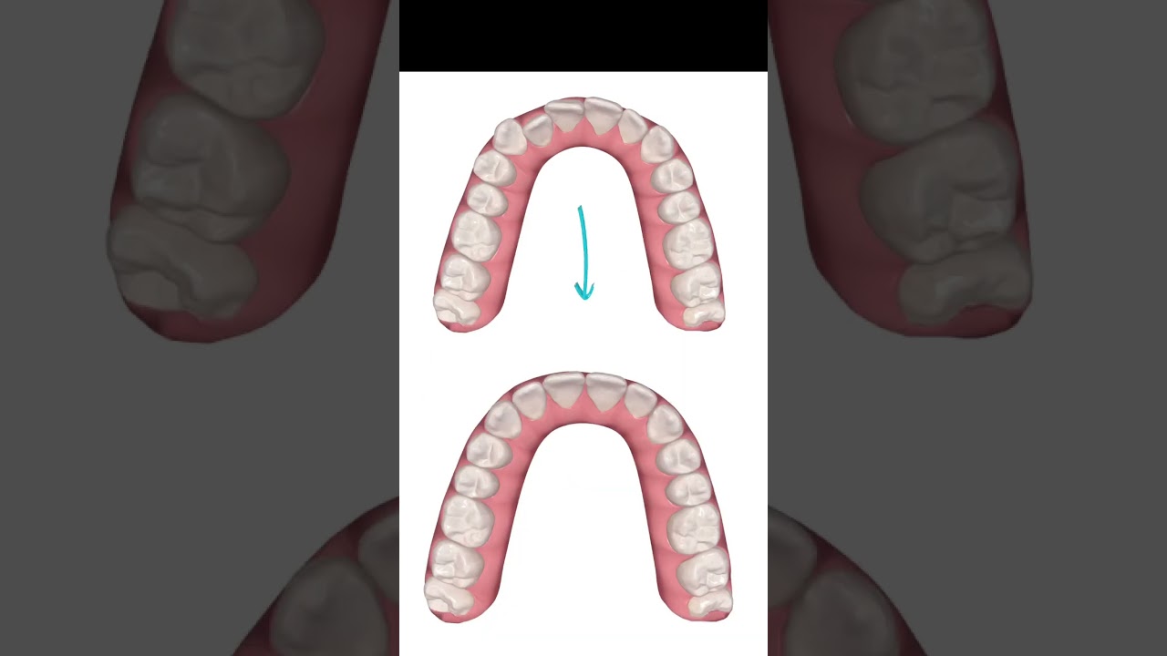 Invisalign Smile Design: Before and After Proposal
