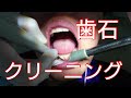 痛っ！？歯科衛生士さんに歯石とってもらいました。歯医者×ＡＳＭＲ／代々木 歯医者