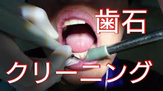 痛っ！？歯科衛生士さんに歯石とってもらいました。歯医者×ＡＳＭＲ／代々木 歯医者