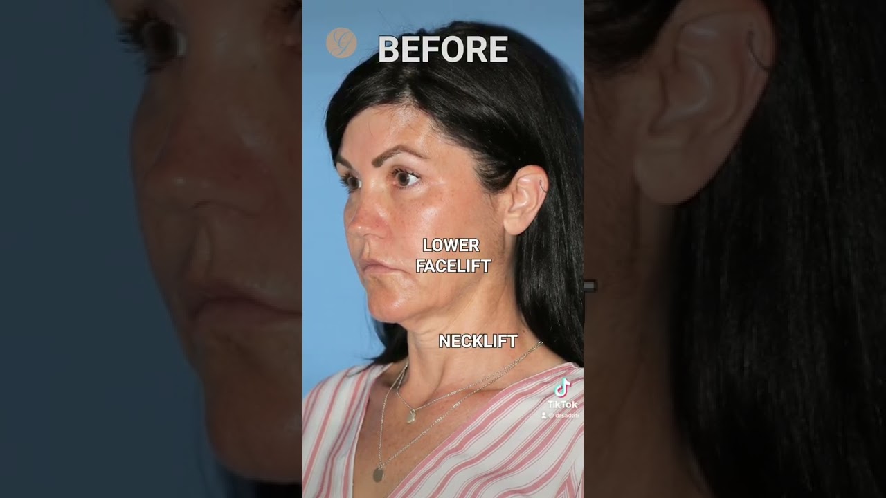 ⁣Snatched Jawline | Dr. Kevin Sadati #facelift #necklift #surgery #doublechin #antiaging