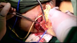 Perineal Defect Reconstruction After Surgery for Advanced or Locally Recurrent Rectal Cancer