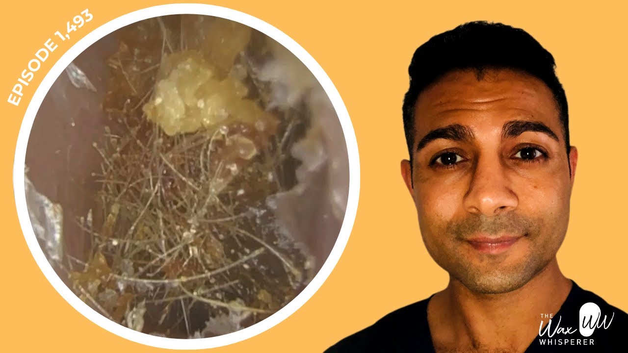 1,493 Hair Nest & Ear Wax Removal Assisted with Crocodile Forceps