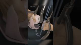 This is how Surgeons Fix broken foot  fingers