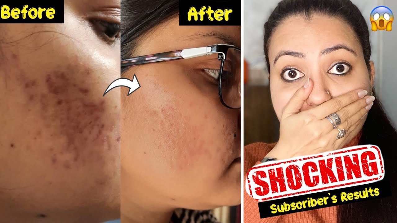 Subscribers Magical Skincare Challenge : Strongest Remedy To Remove Dark Spots,Acne, Pimples Marks💕