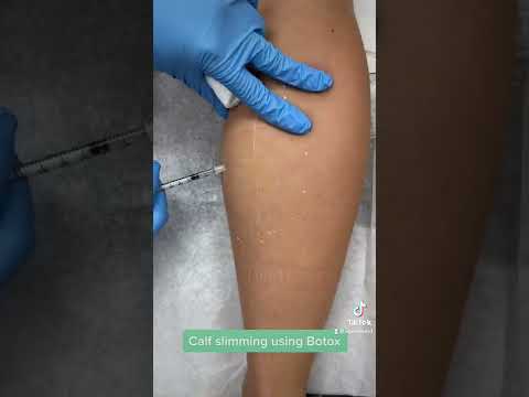 Calf Slimming Treatment by RN Ami - Ageless MD