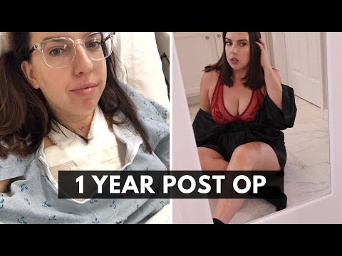 Breast Reduction 1 Year Update: Scars, Cost, Insurance, Before & After, Regrets