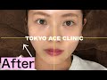 【整形級!】最新の小顔治療の結果がスゴすぎた!!!