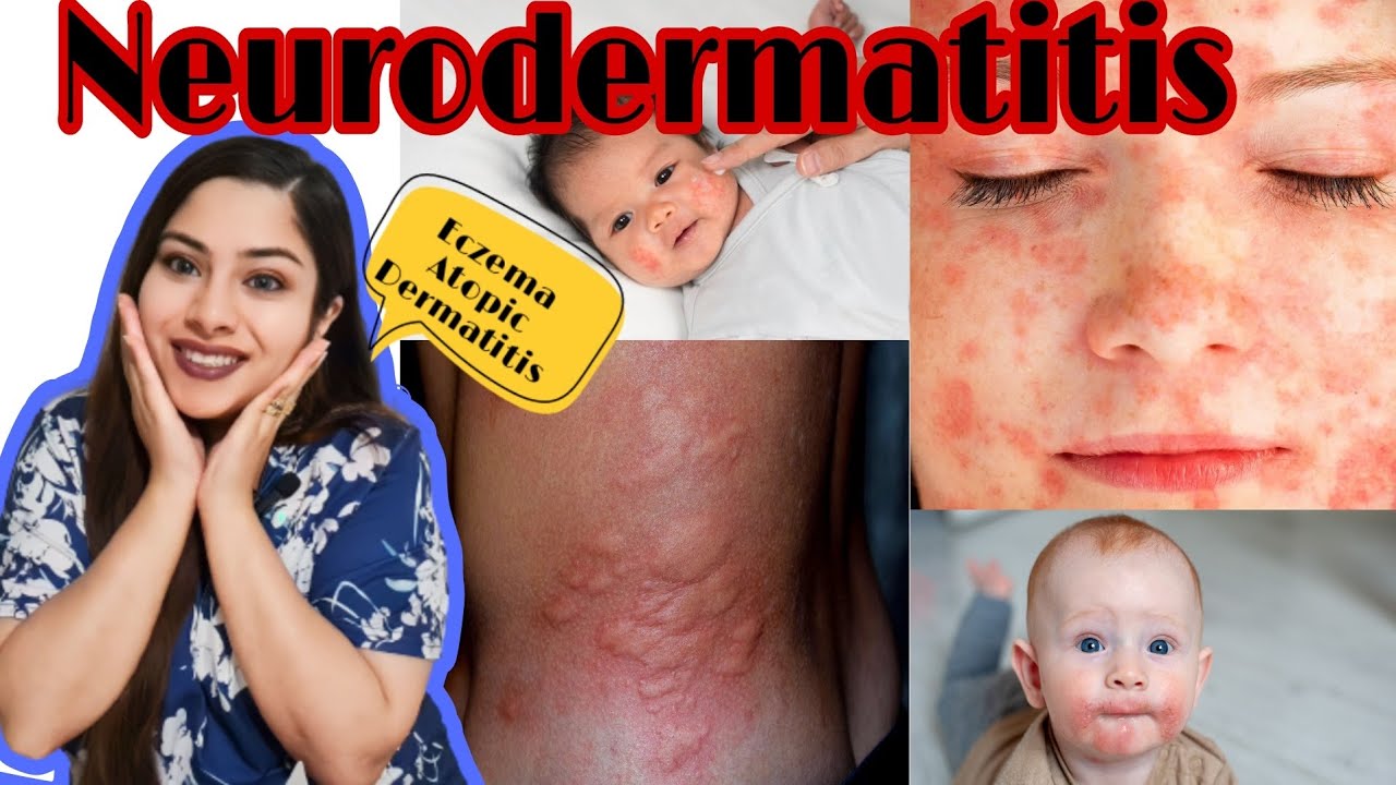 Neurodermatitis Eczema Atopic dermatitis in Urdu eczema 