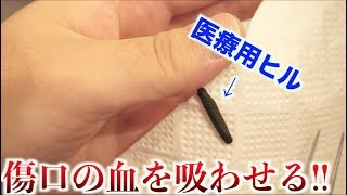 医療用ヒルに傷口の血を吸わせて治療した結果・・・