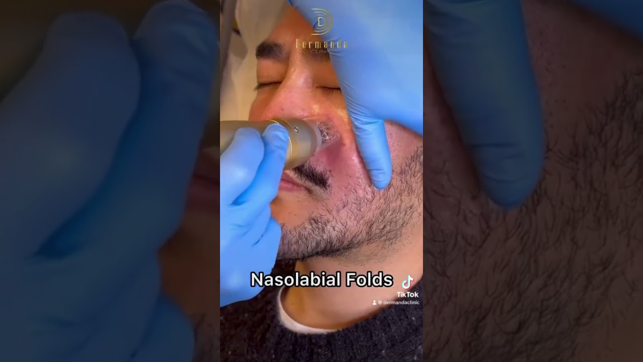 Amazing transformation just after 5 sessions of Sylfirm X for Acne Scars | Dermanda Clinic London