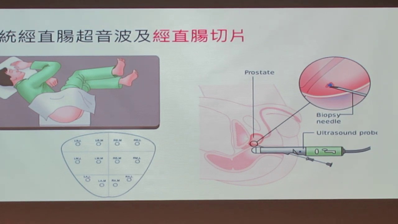 民正新聞記者 蔡永源報導 磁振造影 超音波 融合導引攝護腺切片 Youtube