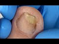 Pedicure Tutorial: Cleaning Thick Toenails【Xue Yidao】