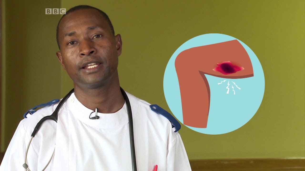 Fahamu namna ya kumsaidia mgonjwa mwenye kidonda?