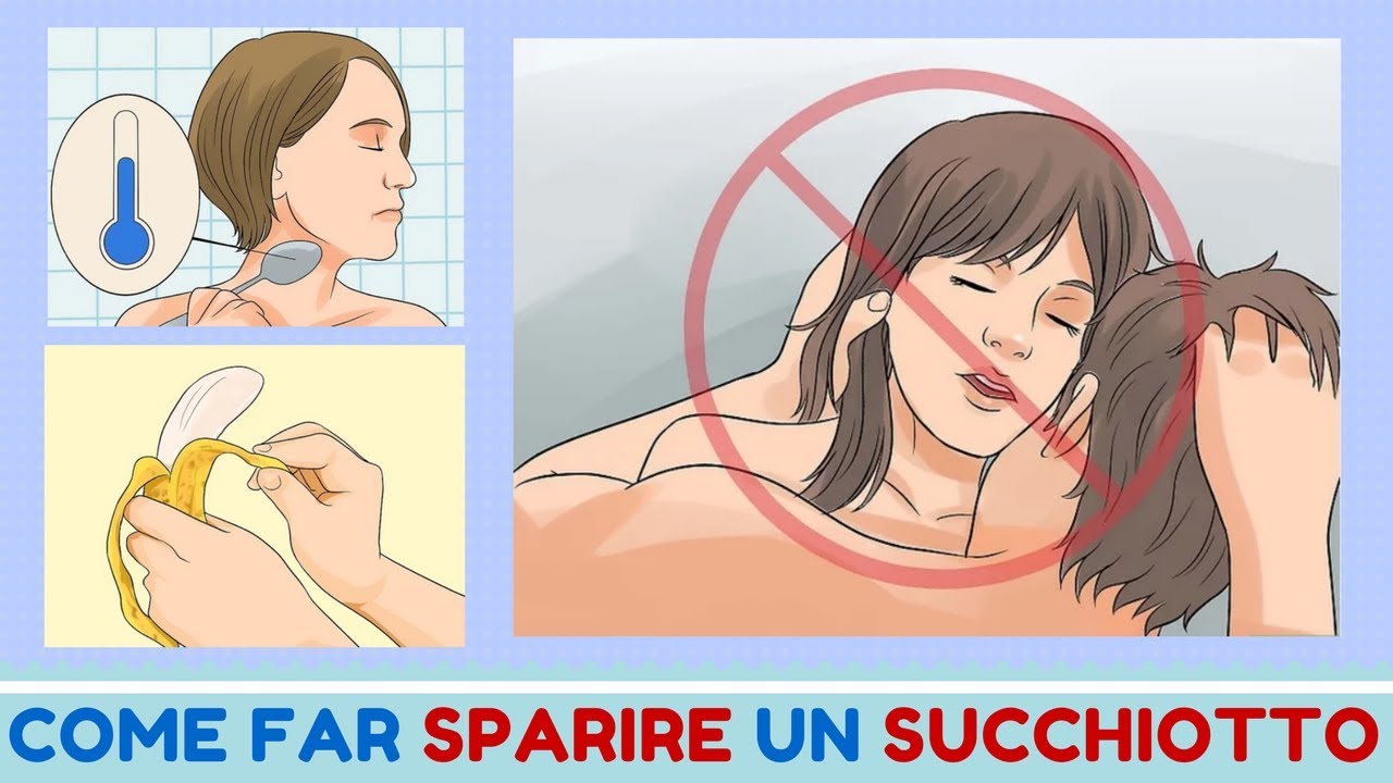 Come nascondere un succhiotto Rimedi per togliere il succhiotto