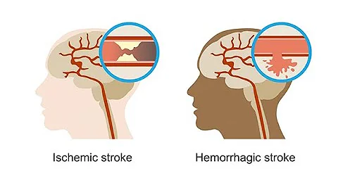 Recognizing hemorrhagic strokes–Neurology Masterclass