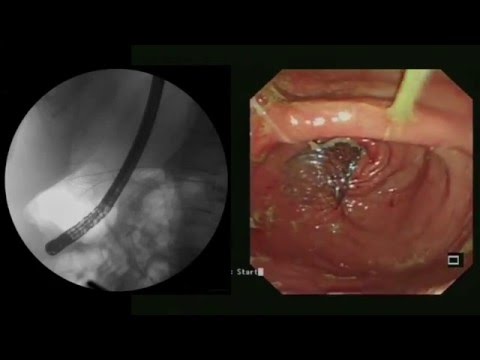 gastric outlet obstruction due to metastatic colorectal cancer youtube gastric outlet obstruction