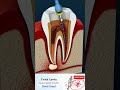 ROOT CANAL TREATMENT- Abscess Tooth - Cavities - endodontics - RCT