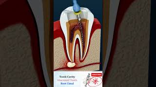 ROOT CANAL TREATMENT- Abscess Tooth - Cavities - endodontics - RCT